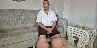 15 YILDIR FİL HASTALIĞIYLA MÜCADELE EDİYOR