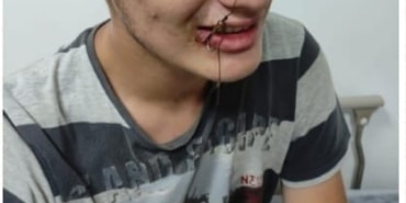 BU KEZ OLTAYA ÇOCUK TAKILDI AĞZINA BALIK OLTASI TAKILAN ÇOCUK, İTFAİYE EKİPLERİNCE KURTARILDI