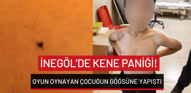 Bursa İnegöl’de oyun oynayan 7 yaşındaki çocuğun göğsünden kene yapıştı