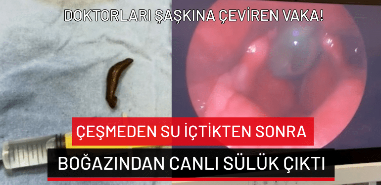 Çeşmeden su içtikten sonra boğazından canlı sülük çıktı: Doktorları şaşkına çeviren vaka!